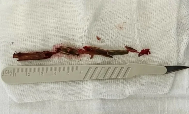 اكتشاف غصن خشبي بطول 12 سم داخل جمجمة رجل روسي من قبل الأطباء