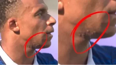 تقارير: كيليان مبابي يعاني من مرض جلدي قبل المباريات المقبلة