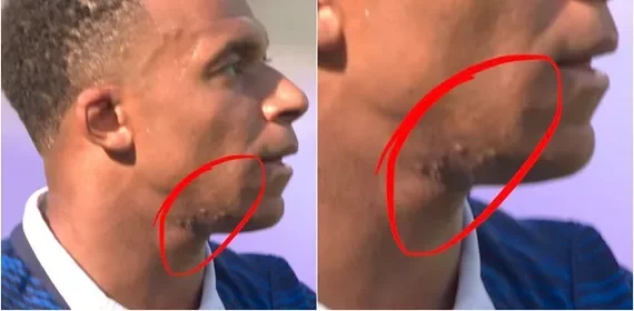 تقارير: كيليان مبابي يعاني من مرض جلدي قبل المباريات المقبلة