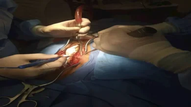 جدل حول استغلال أعضاء المحكوم عليهم بالإعدام في العراق بعد تصريحات حسام موافي