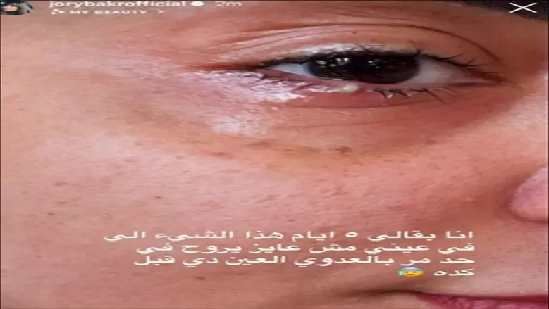 جوري بكر تكشف عن إصابتها بعدوى في عينها- ماذا قالت؟