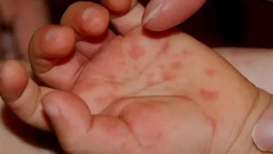منظمة الصحة العالمية: 22 ألف حالة حصبة في بنجلاديش منذ مارس